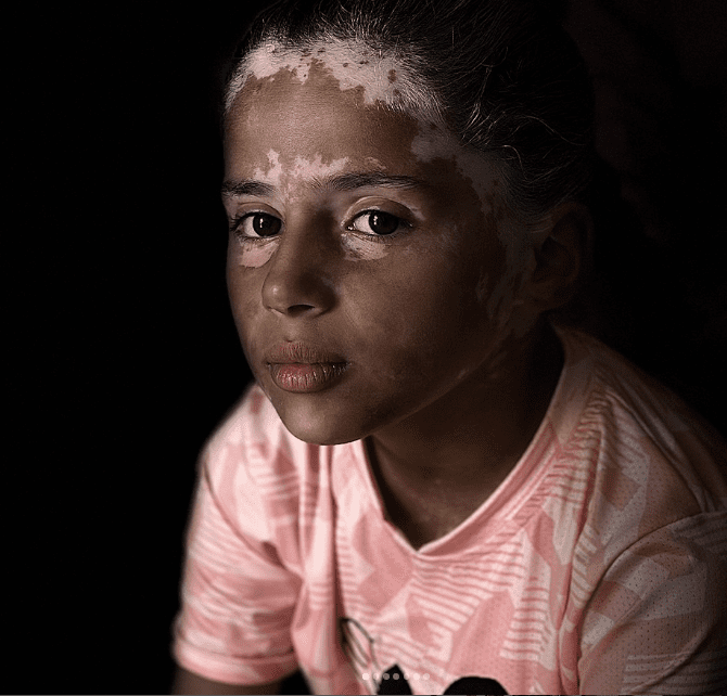 Palestinian Girl Develops Vitiligo Due to Trauma from Israeli Airstrikes